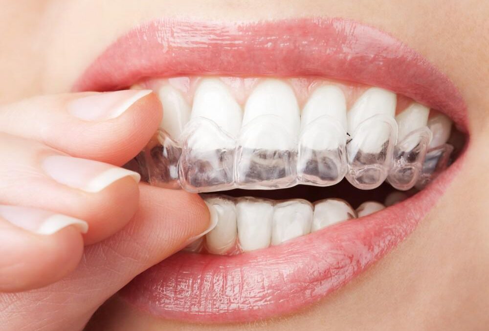 Invisalign in Forest Hills