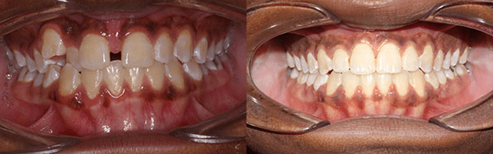 Invisalign First - Before and After - See Correction on an 7 year