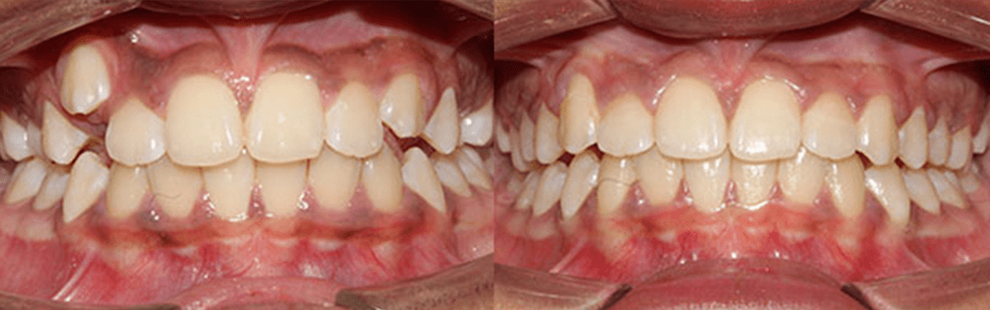 Before and After - Forest Hills, NY Forest Hills Orthodontic Associate