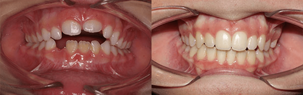 Before and After - Forest Hills, NY Forest Hills Orthodontic Associate