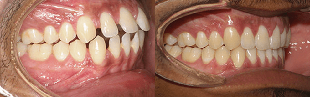 Before and After - Forest Hills, NY Forest Hills Orthodontic Associate