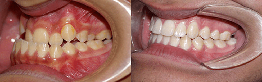 Before and After - Forest Hills, NY Forest Hills Orthodontic Associate