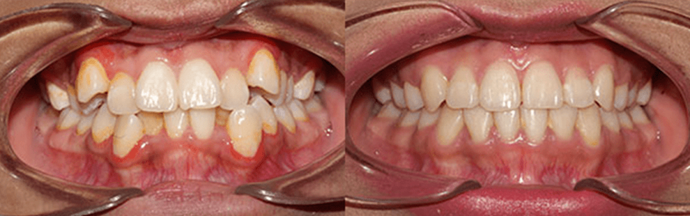 Before and After - Forest Hills, NY Forest Hills Orthodontic Associate