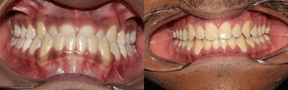 Before and After - Forest Hills, NY Forest Hills Orthodontic Associate