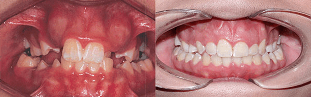 Before and After - Forest Hills, NY Forest Hills Orthodontic Associate